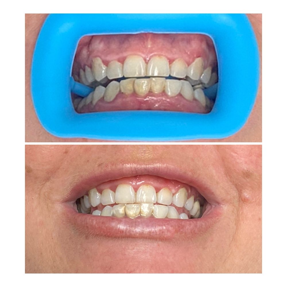 Deep Stains Teeth Whitening