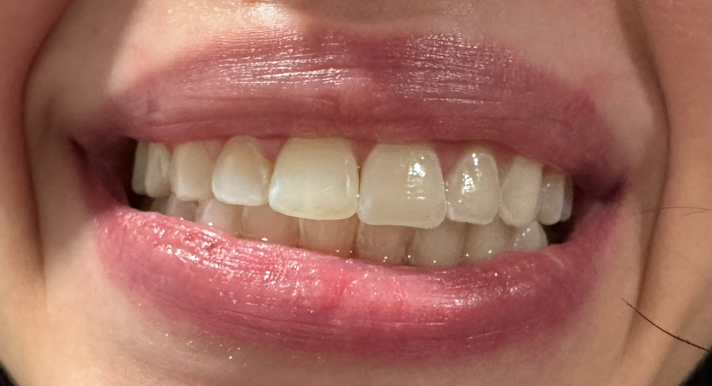 Teeth Whitening - Touch Up