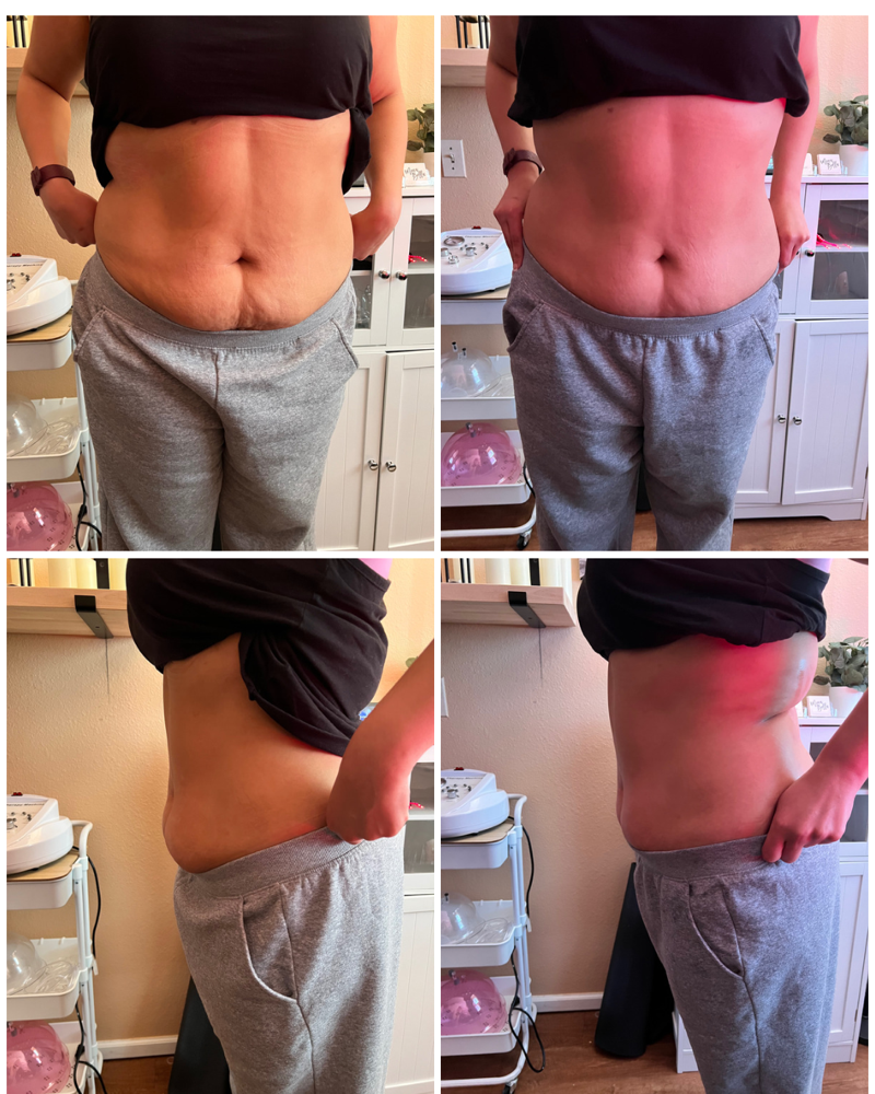 Cavitation And Radiofrequency at Nazareth Beauty in Aurora, CO