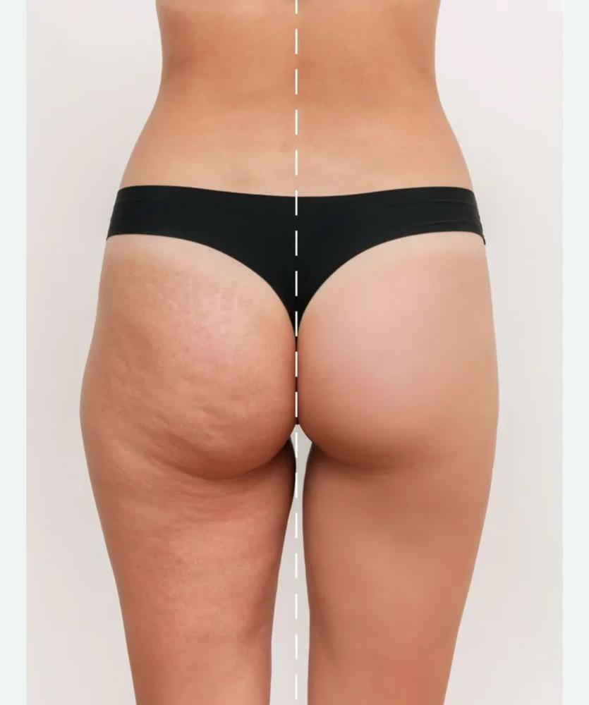 Cryo T Glute Lift Elevate