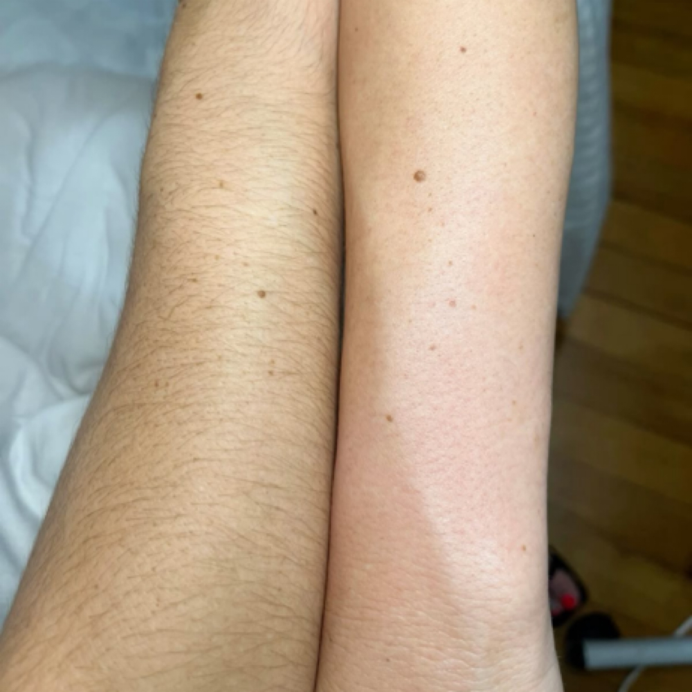 Arms Hair Removal (8 Sessions) at Nenusk Aesthetics in Long Island City, NY
