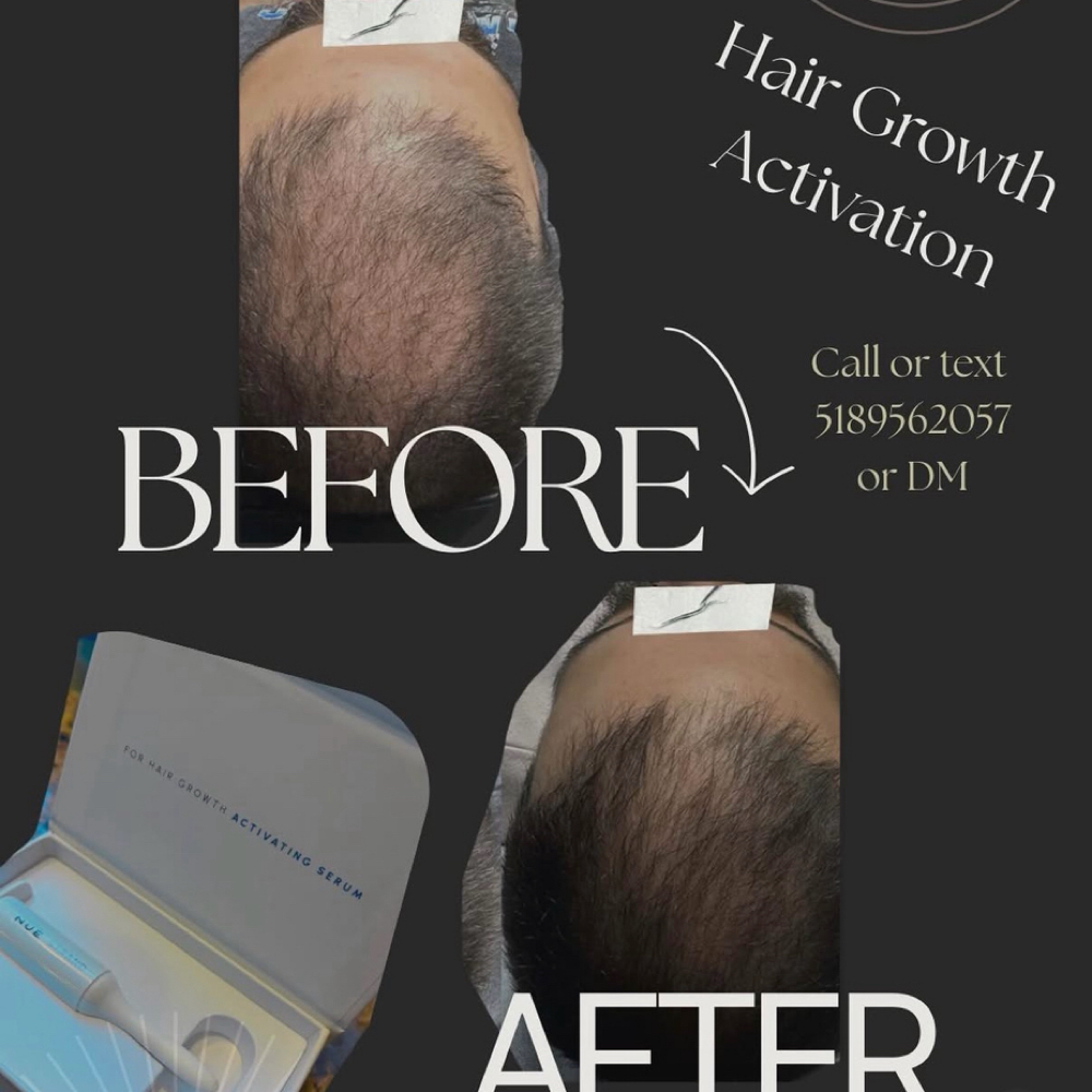 Hair Restoration Needling at ArteSana by Steph in Altamont, NY