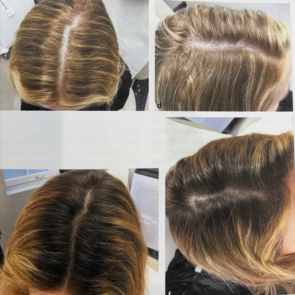 Hair Restoration Needling at ArteSana by Steph in Altamont, NY