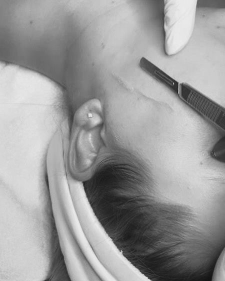 Glow & Refresh Hydroderm Facial