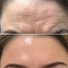 Skin Tightening Forehead Lines