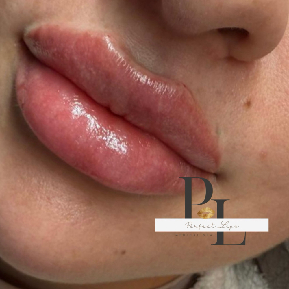 2 ML Juvederm / Restylane