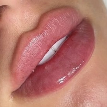 2 ML Juvederm / Restylane