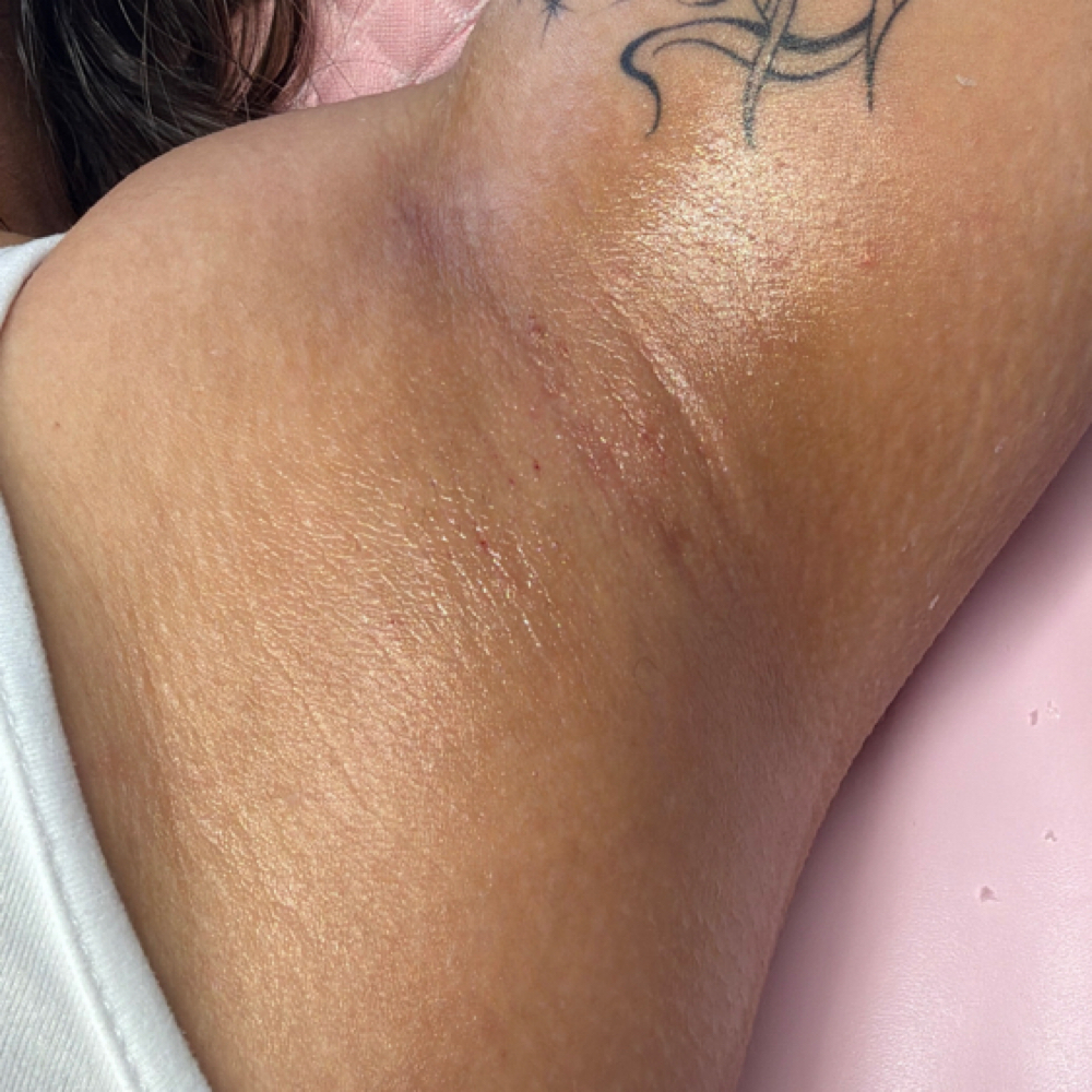 UNDERARMS at Soft Stone Esthetics in Bladensburg, MD