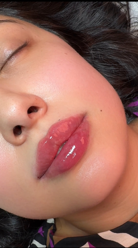 Lip Augmentation