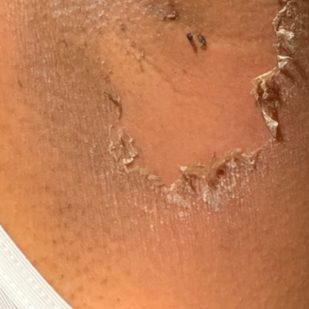 Underarm Skin Lightenining 🤍