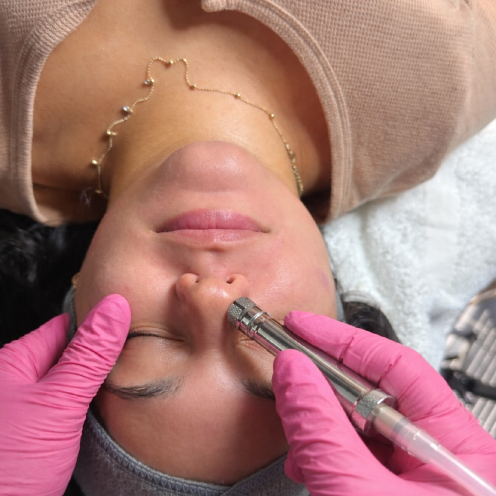 Microderm Resurfacing Facial at Eternal Glow Med Spa in Waddell, AZ
