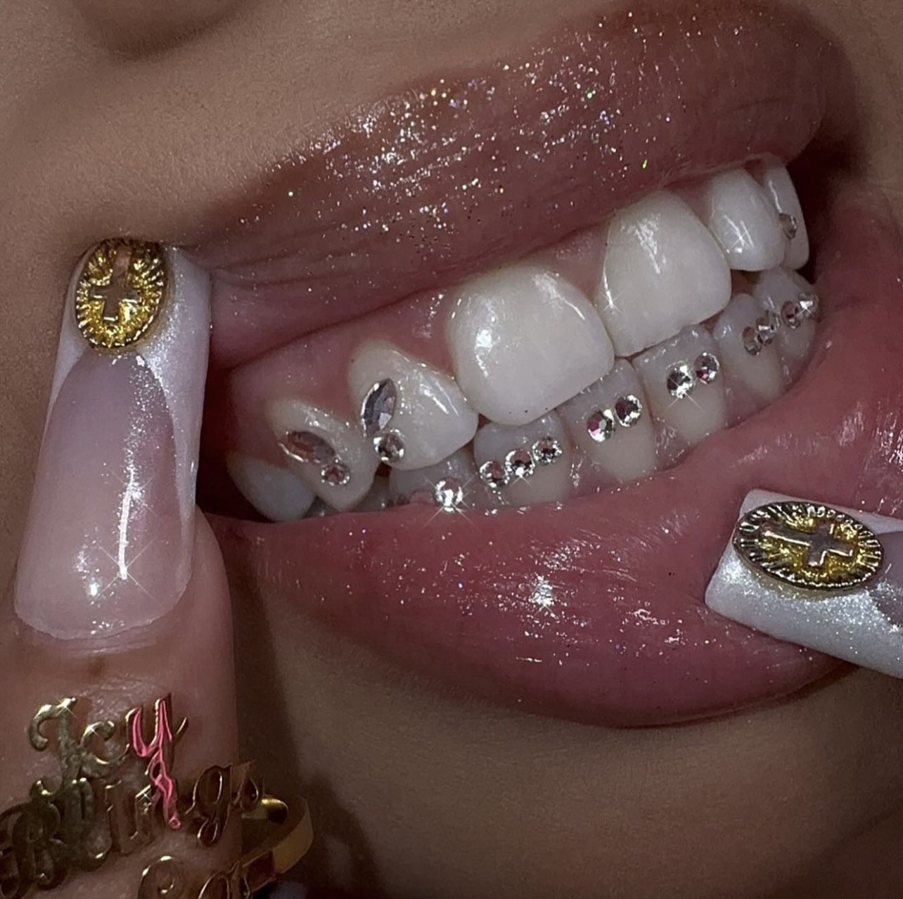 Braces - Grill