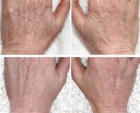 Fibroblast rejuvenation treatment