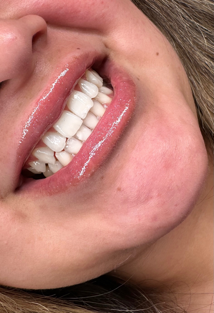 30 Min Teeth Whitening