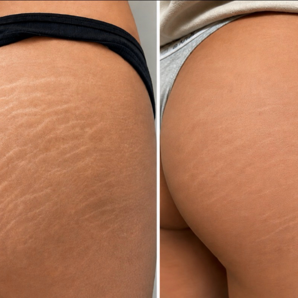 Stretch Mark Camouflage | Small Are at Skin Theory Collective in Port Richey, FL