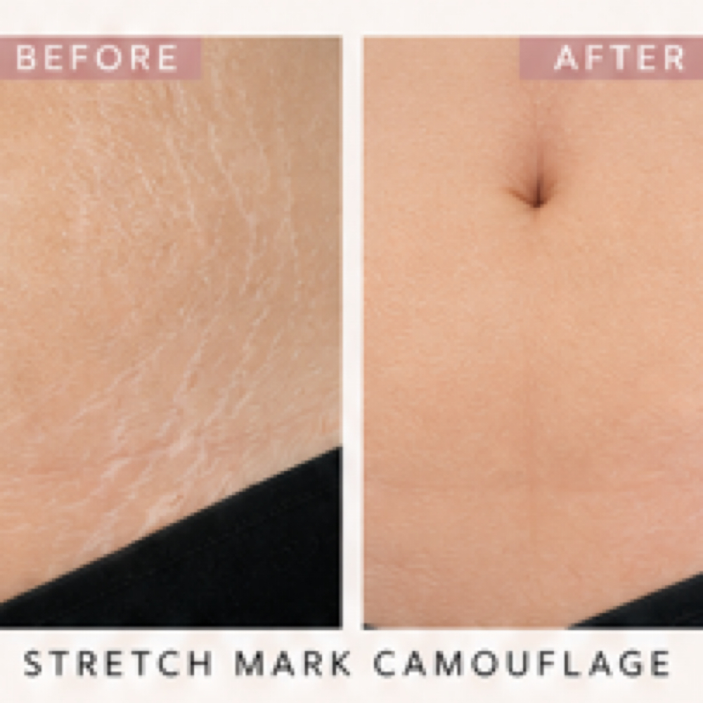 Stretch Mark Camouflage | Small Are at Skin Theory Collective in Port Richey, FL