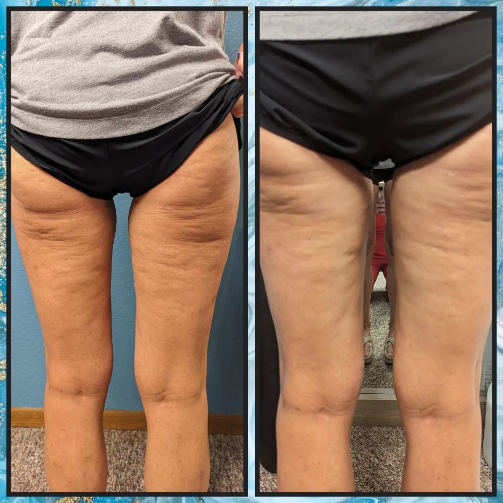 Cellulite Treatment