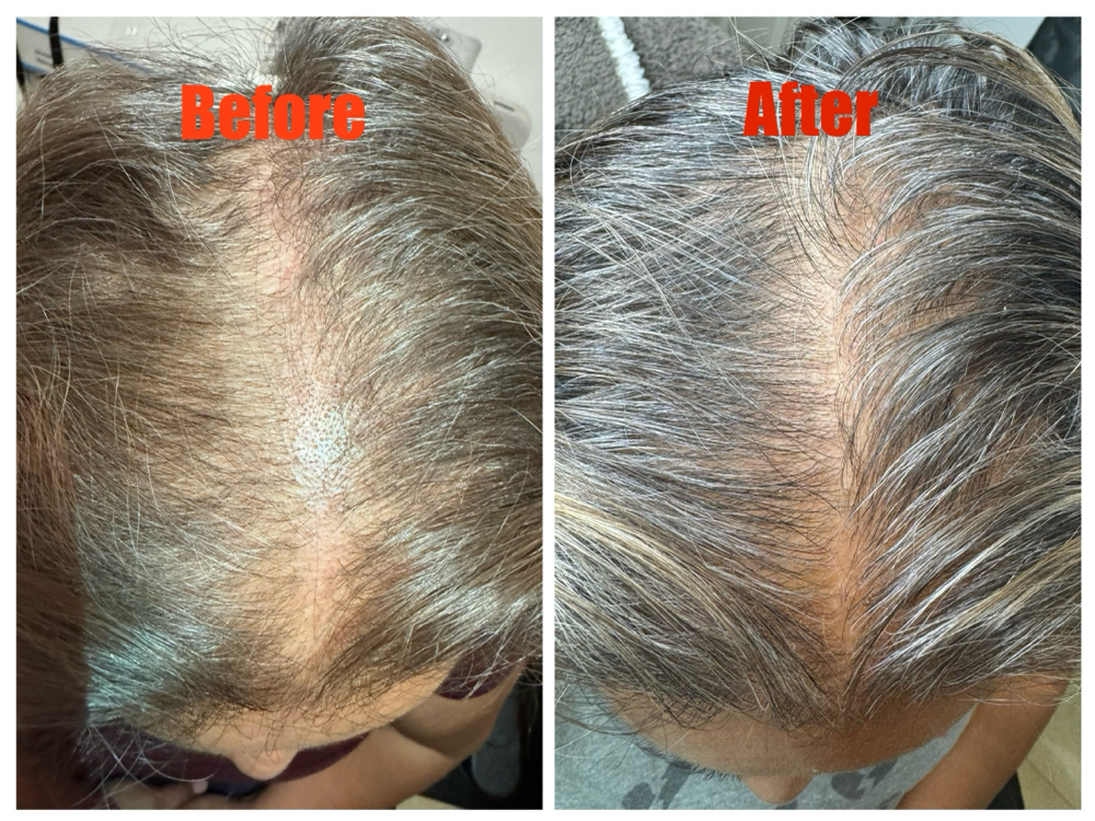 Hair Restoration Treatments NOT PRP