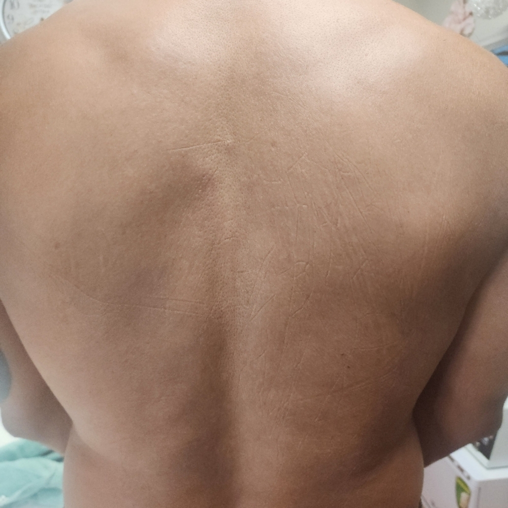 Men's Back Facial at BELLA'S SENSES SPA by Angie in Coral Springs, FL