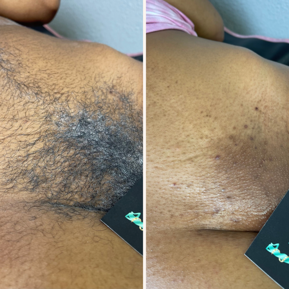 Brazilian Wax