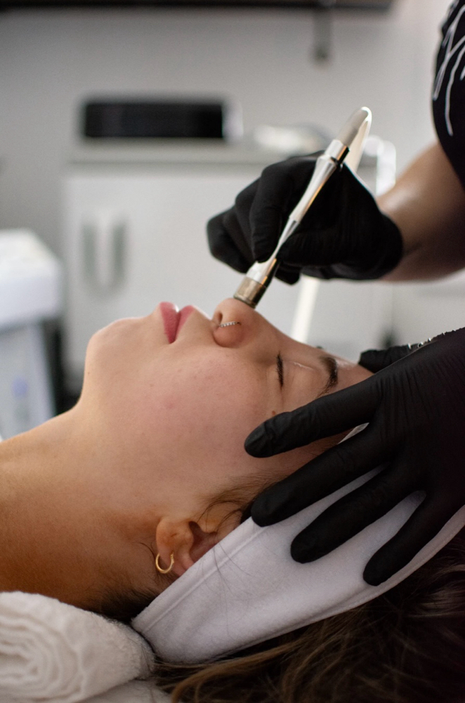 Microdermabrasion