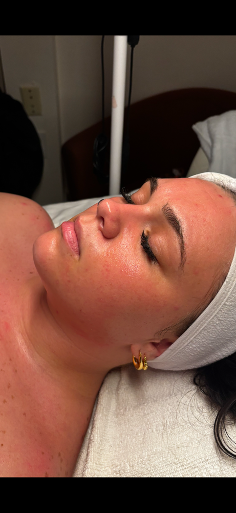 Dermaplaning at Leigh Radiance in Staunton, VA