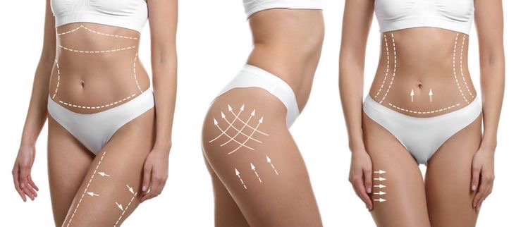 Non Invasive BBL