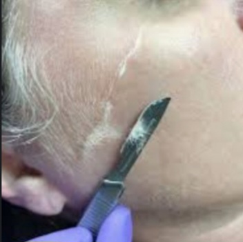 Derma Plane Add On