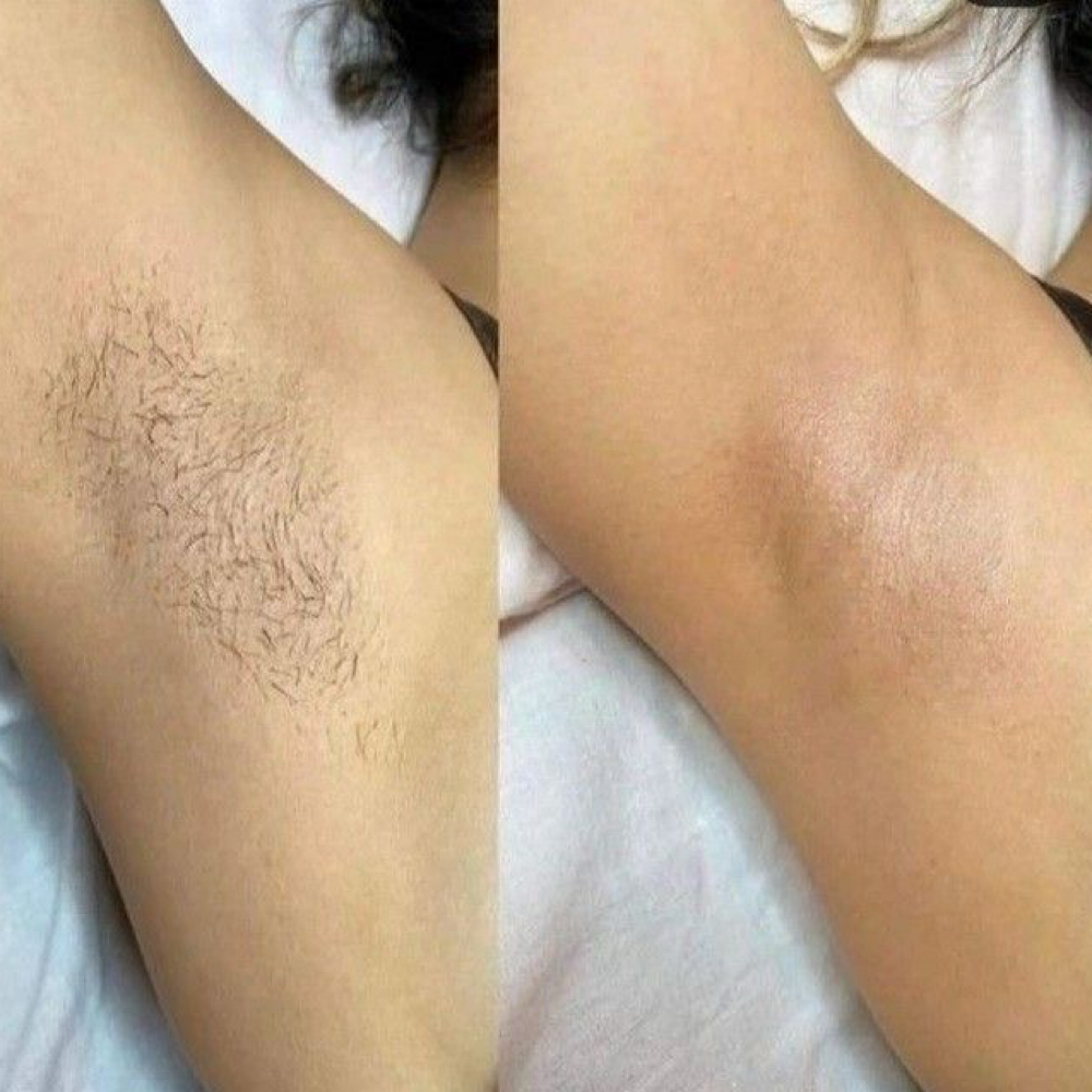 Laser Hair Removal - Underarms at Radiance Beauty Studio in McAllen, TX