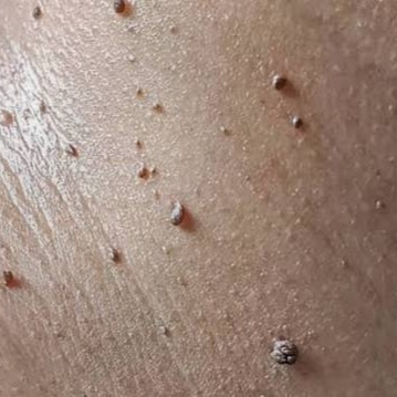 Skin Tag Removal at JB Skin Artistry in Phoenix, AZ