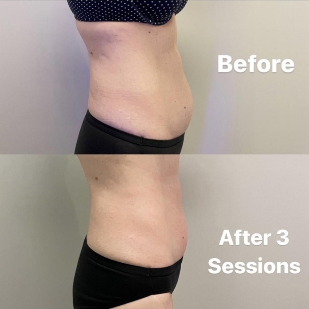 Body Sculpting, Body Contouring at De lux beauty bar in New York, NY