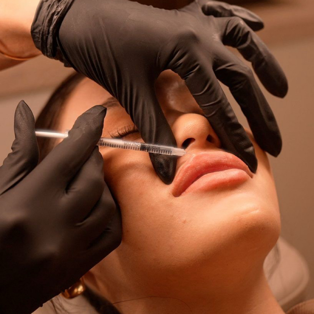 Lip Filler 1 Syringe at The Skin Room Aesthetic and Wellness LLC in Longview, TX