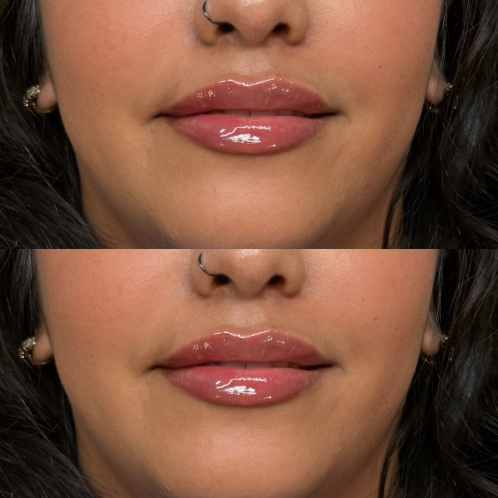 Lip Filler at Lavish.withLo in Sunnyvale, TX