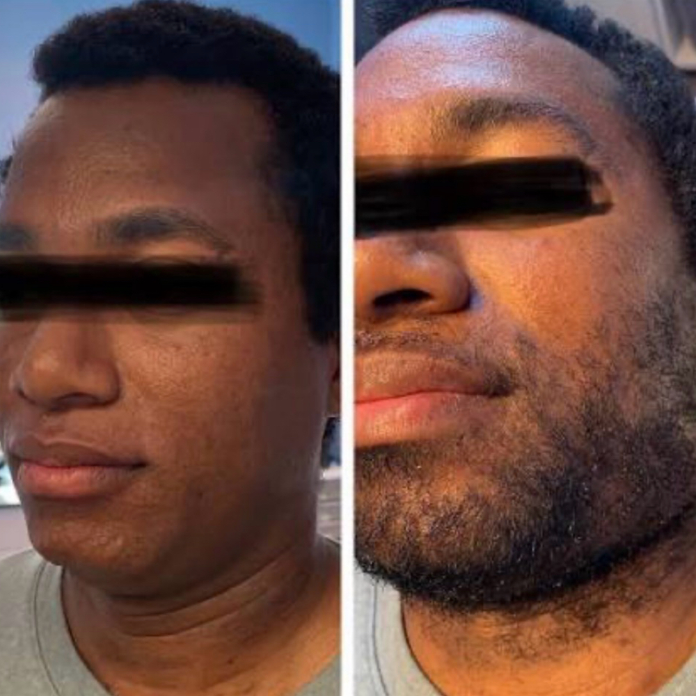 Chin / Beard Waxing at Kookie Paradise in Lakewood, WA