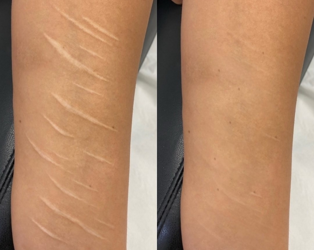 Package for small SCARS in 1 Area