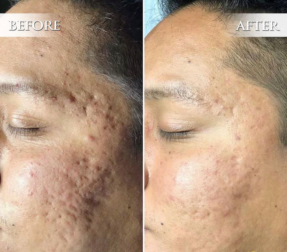 Acne Scar Removal Fibroblast