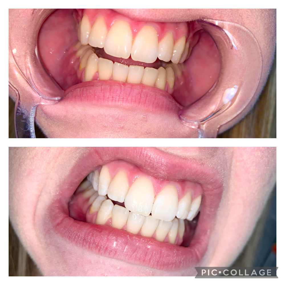 Teeth Whitening Half Session