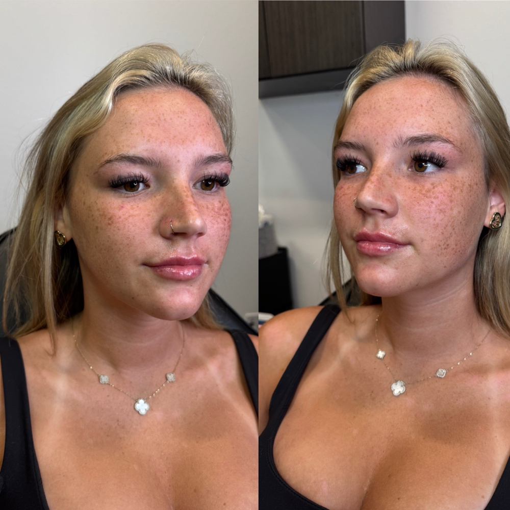 Lip fillers promo