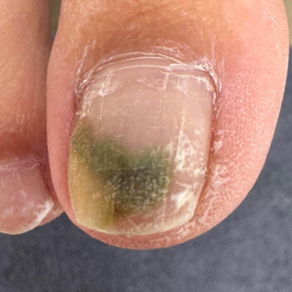 Nail Color Correction Pedicure at Southern Oregon PEDICURE CLINIC in Medford, OR