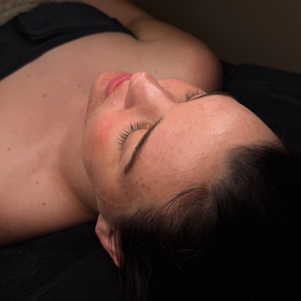 Chemical Peel - Add On at KB Beauty in Burleson, TX
