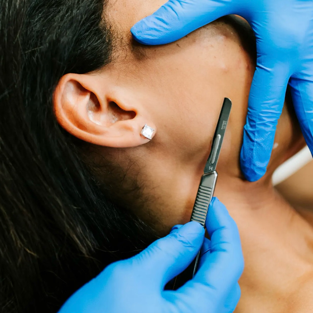 Dermaplane Facial