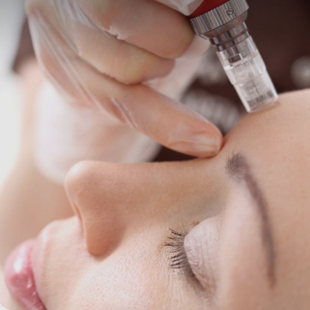 Microneedling (CIT) at Cristina  Oliveira
