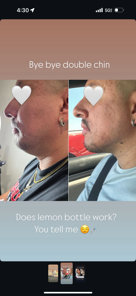 Fat Dissolve Injections