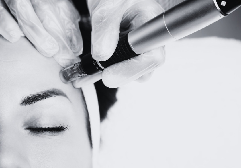 microneedling consultation