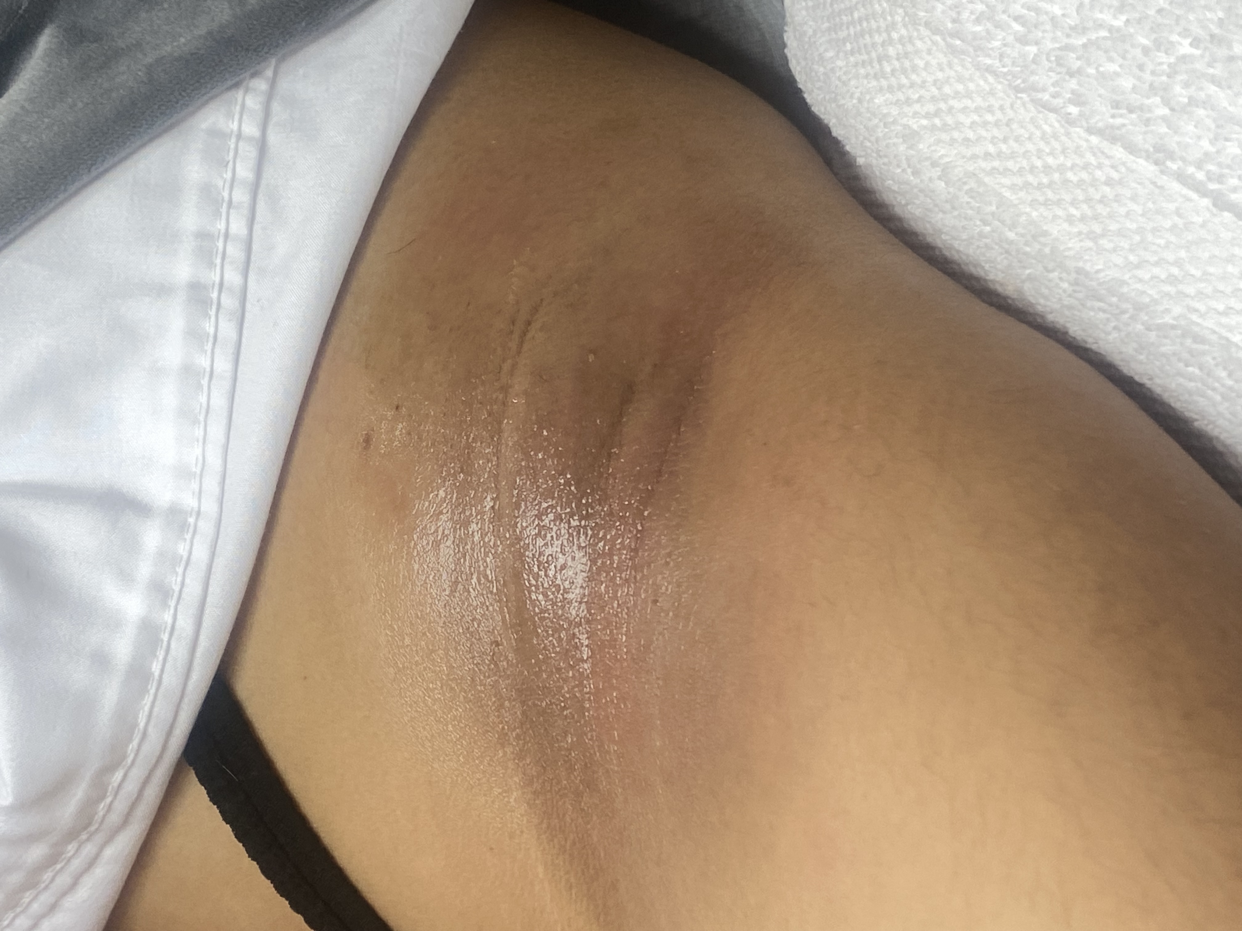 Under Arm Hair Removal