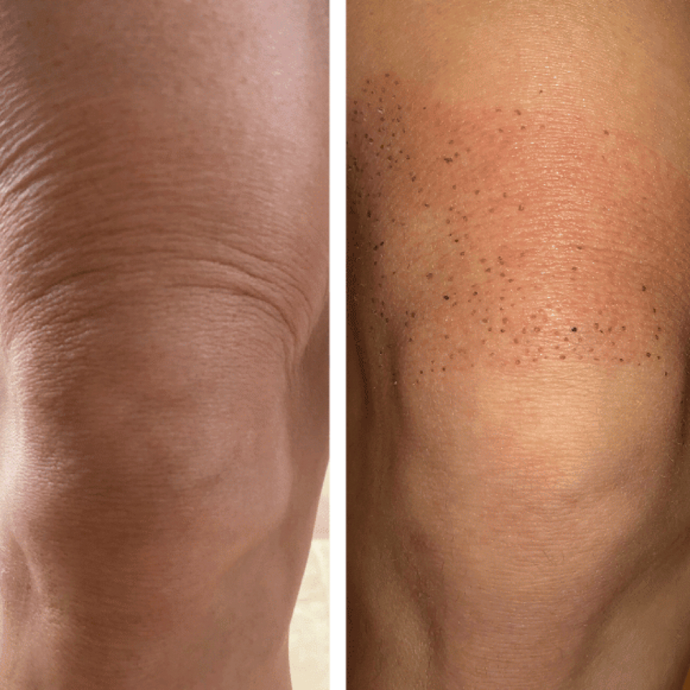 Plasma IQ Advanced Skin Renewal (B) at Empower Aesthetics in Canyon Lake, TX