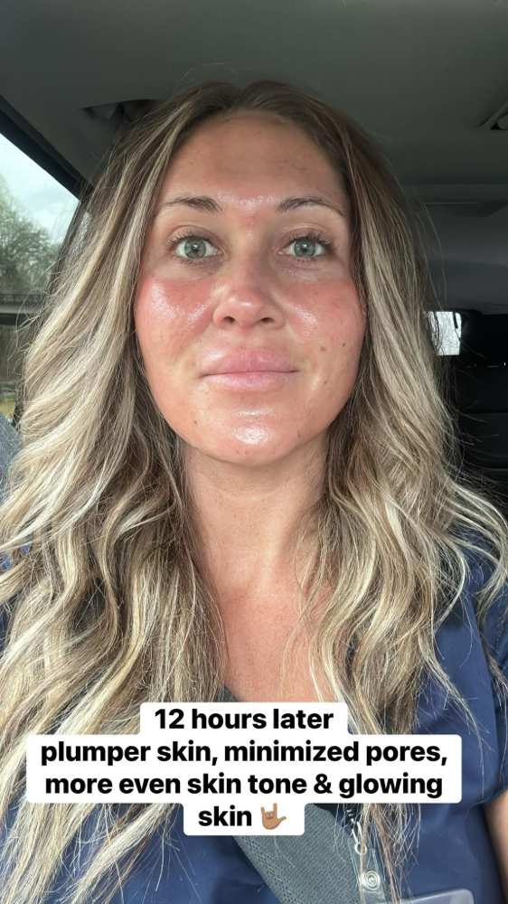 The Collagen Renewal: Microneedling at Ciao Bellä Esthetics WNC in Asheville, NC