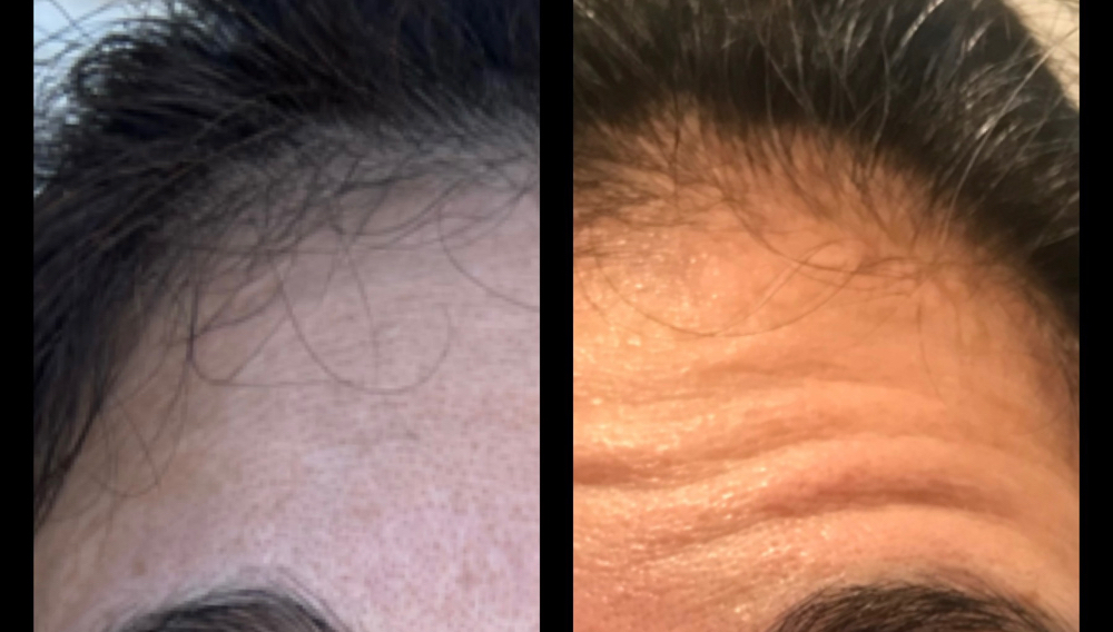 Anti-wrinkle Treatment