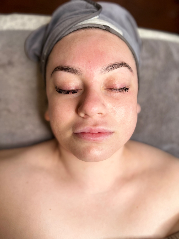 Acne Facial + High Frequency