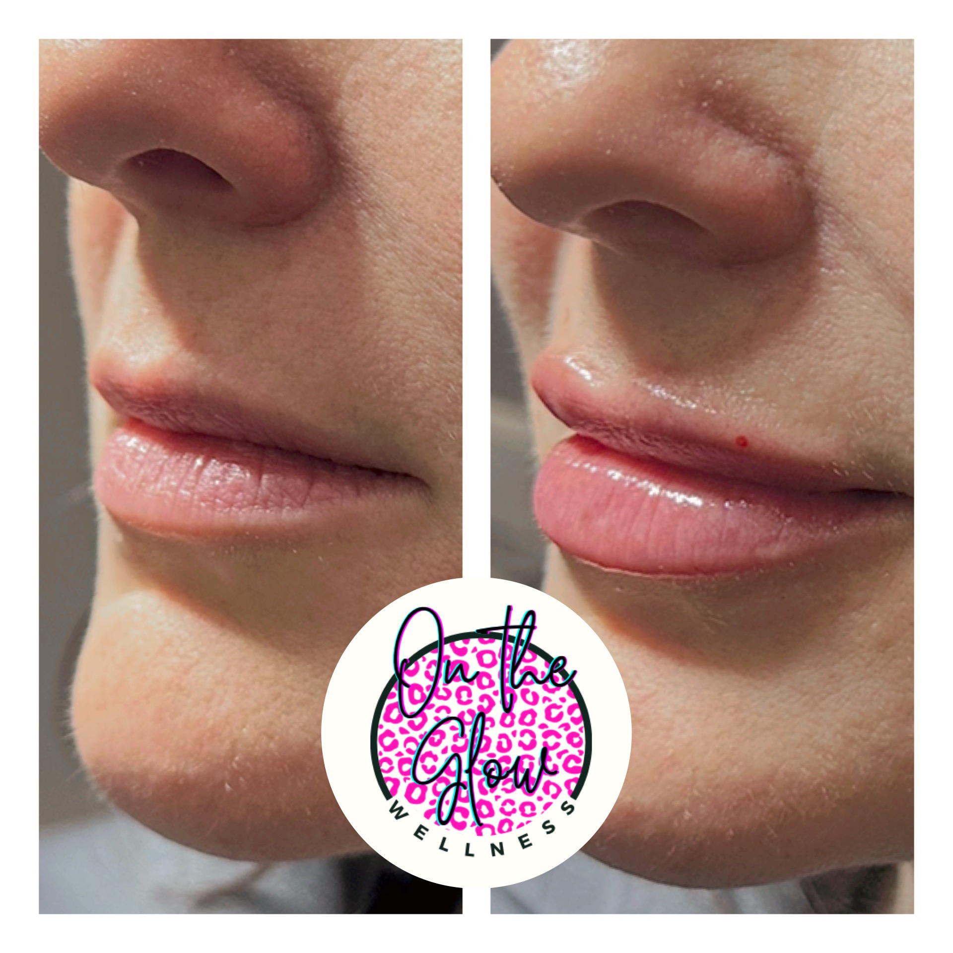 Lip Filler